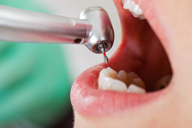 Best Emergency Dental Extractions in Freeport, FL
